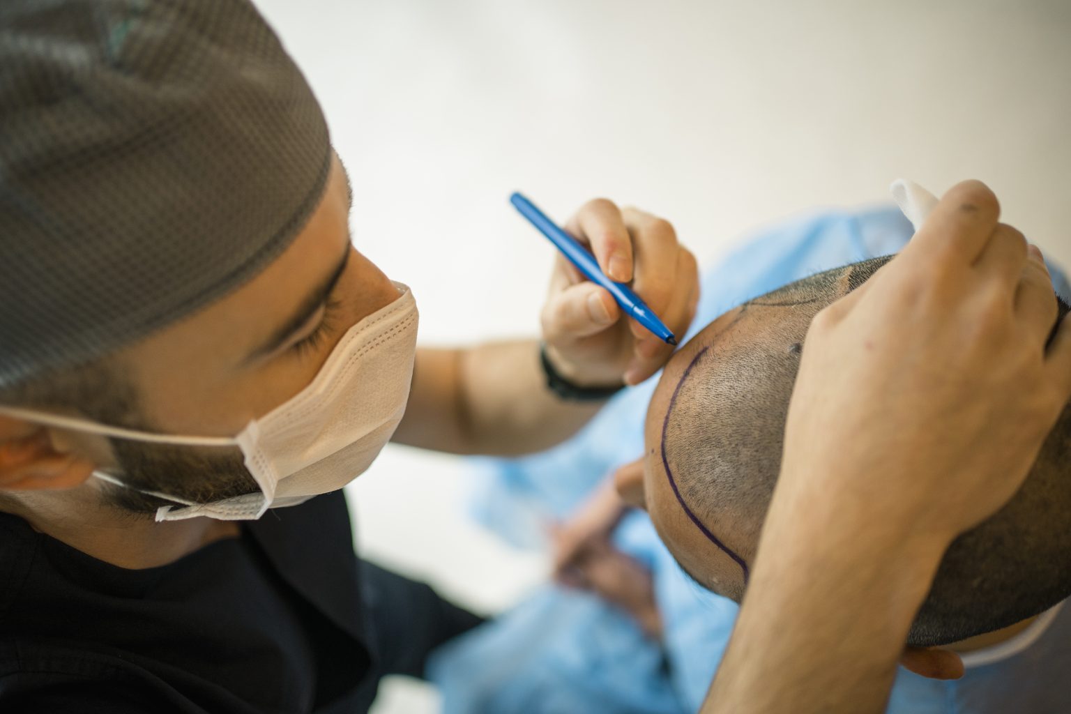 permanent hair transplant in California, USA