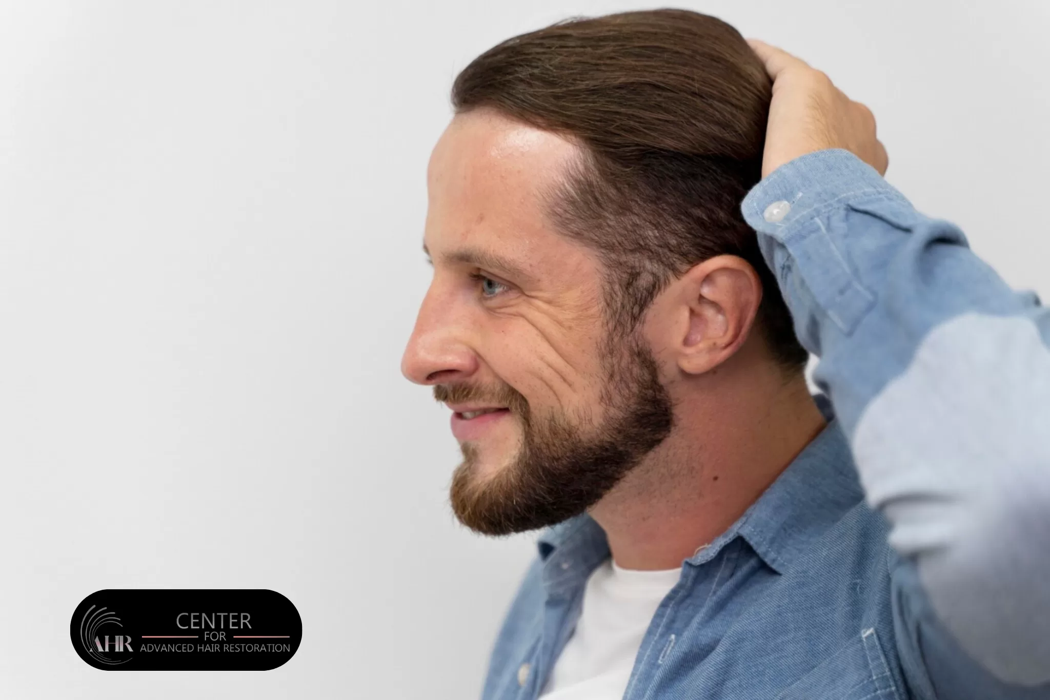 What Happens 10 Years After a Hair Transplant Long-Term Results & Realistic Expectations