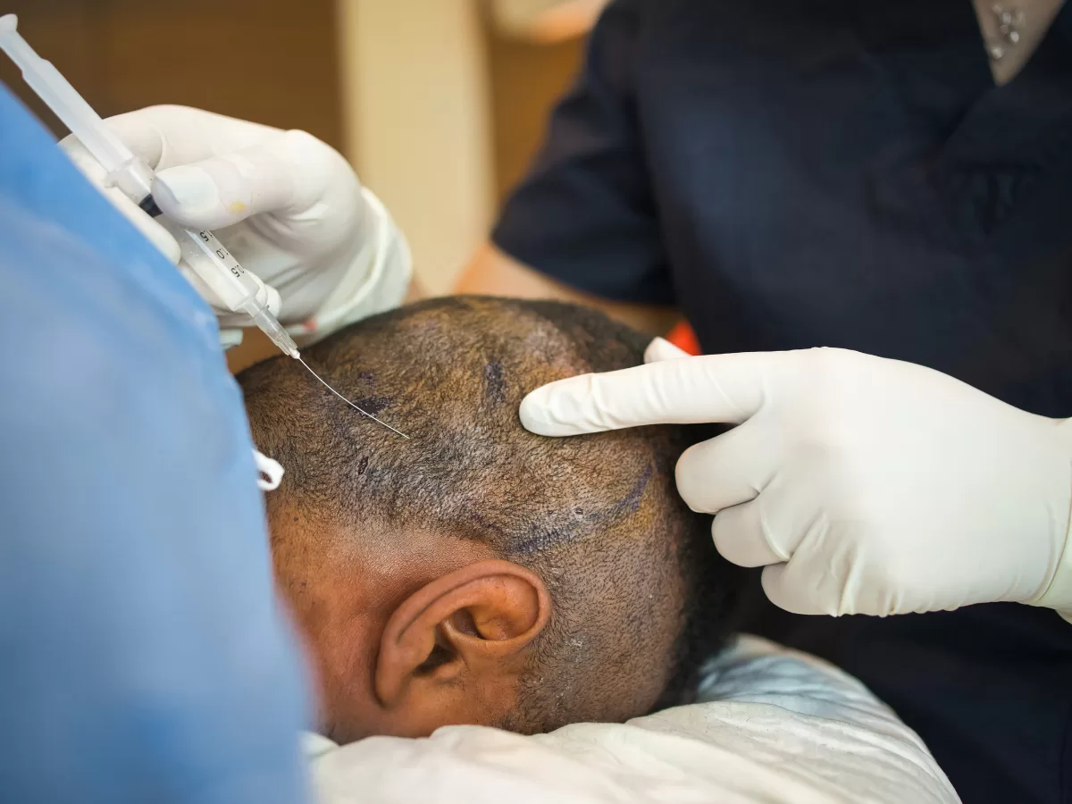 A Decade Later: What to Expect 10 Years After a Hair Transplant