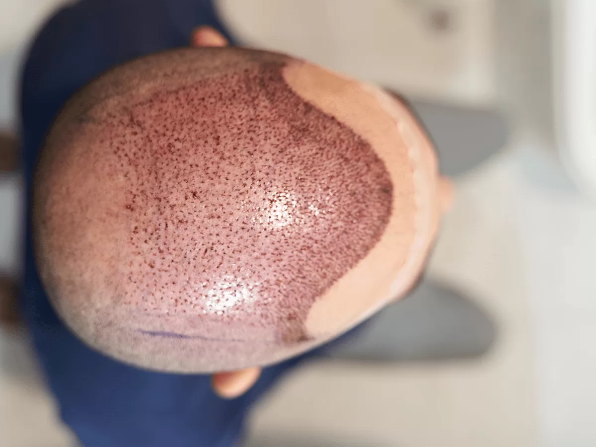 What is the Best Age for a Hair Transplant? A Surgeon's Guide to Perfect Timing
